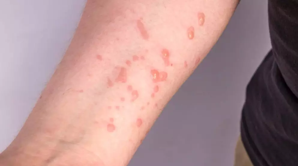 Brasil Registra 140 Casos Confirmados de Mpox em 2026 | Saúde Pública